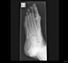 Foot  (Left) X-ray 0001.jpg