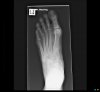 Foot  (Left) X-ray 0002.jpg