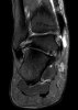 Everted calcaneus MRI.jpg