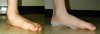 Pediatric Flatfoot With and Without Orthosis 1.jpg