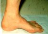 Pronated Foot B.jpg